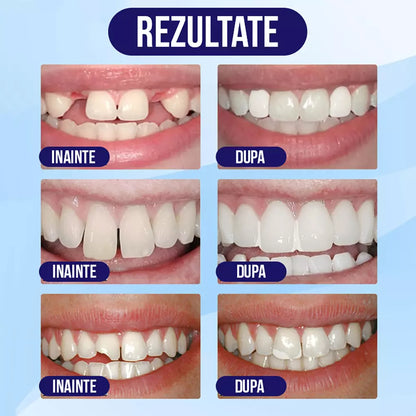 Dientes.Fix gránulos para reparación instantánea de dientes, 30ml